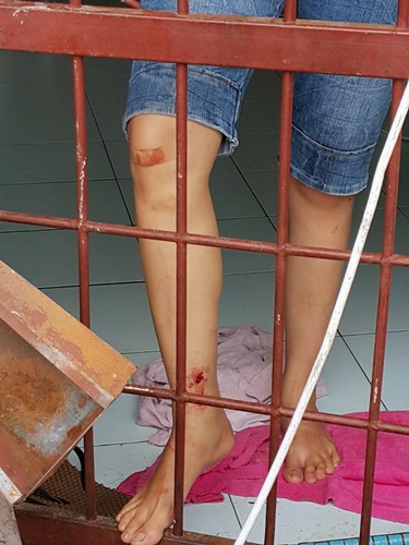 女子的右脚擦流血。